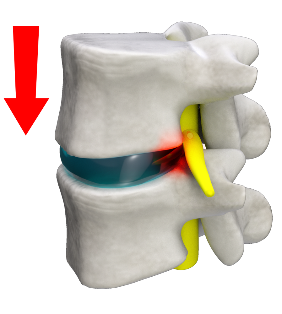 Spinal Stenosis